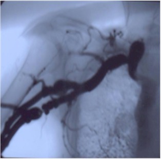 fistulas_arteriovenosas_hemodialisis_4