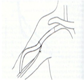 fistulas_arteriovenosas_hemodialisis_5 fistulas_arteriovenosas_hemodialisis_5