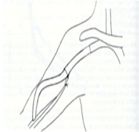 fistulas_arteriovenosas_hemodialisis_5