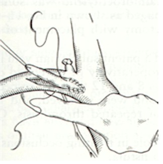 fistulas_arteriovenosas_hemodialisis_8 fistulas_arteriovenosas_hemodialisis_8