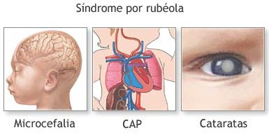 rubeola rubeola