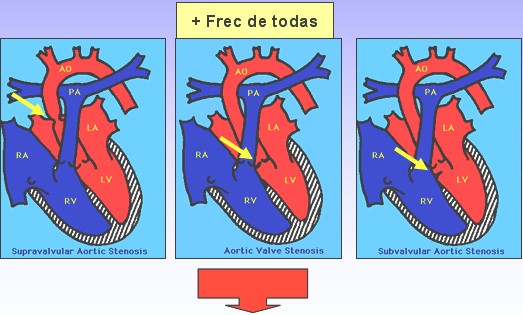 estenosis_aortica