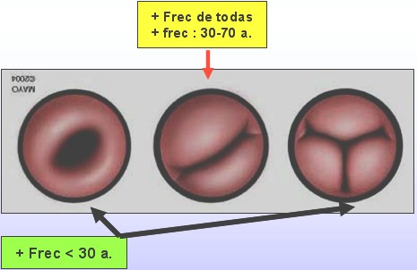 estenosis_aortica2 estenosis_aortica2