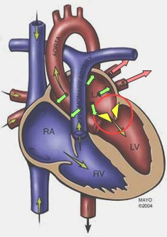 estenosis_mitral