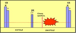 estenosis_mitral2