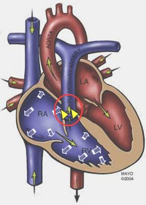 estenosis_pulmonar estenosis_pulmonar
