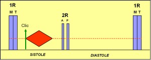 estenosis_pulmonar2 estenosis_pulmonar2