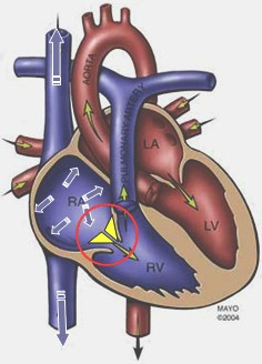 estenosis_tricuspidea estenosis_tricuspidea