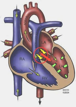 insuficiencia_aortica