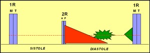 insuficiencia_aortica3