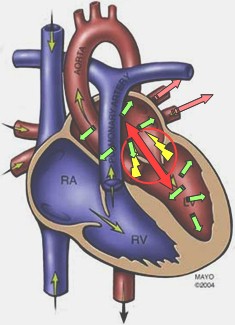 insuficiencia_mitral