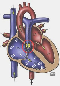 insuficiencia_pulmonar insuficiencia_pulmonar