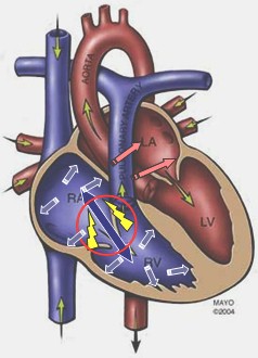 insuficiencia_tricuspidea