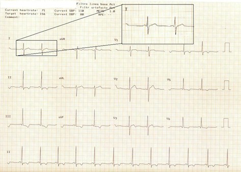 electrocardiograma_ECG_QT/ECG_EKG_intervalo_QT_1