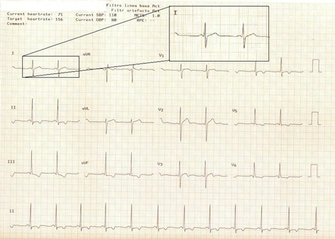 electrocardiograma_ECG_QT/ECG_EKG_intervalo_QT_1 electrocardiograma_ECG_QT/ECG_EKG_intervalo_QT_1