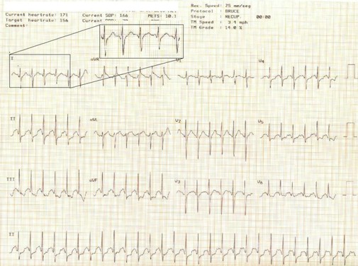 electrocardiograma_ECG_QT/ECG_EKG_intervalo_QT_2