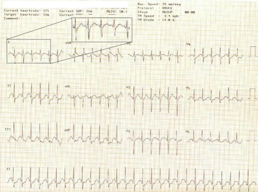 electrocardiograma_ECG_QT/ECG_EKG_intervalo_QT_2 electrocardiograma_ECG_QT/ECG_EKG_intervalo_QT_2