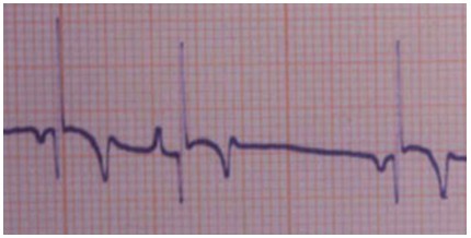 emergencias/guia_urgencia_extrasistole_ventricular emergencias/guia_urgencia_extrasistole_ventricular