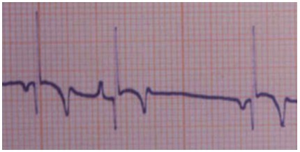 emergencias/guia_urgencia_extrasistole_ventricular