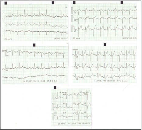 emergencias/guia_urgencia_patron_sindrome_brugada emergencias/guia_urgencia_patron_sindrome_brugada