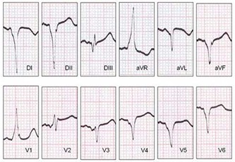 emergencias/guia_urgencia_sindrome_Wolff-Parkinson-White