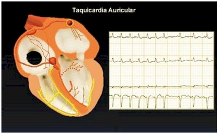 emergencias/guia_urgencia_taquicardia_auricular