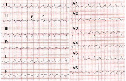 emergencias/guia_urgencia_taquicardia_ventricular