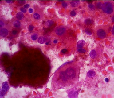 melanomas/melanoma_anatomia_patologica_microscopio melanomas/melanoma_anatomia_patologica_microscopio