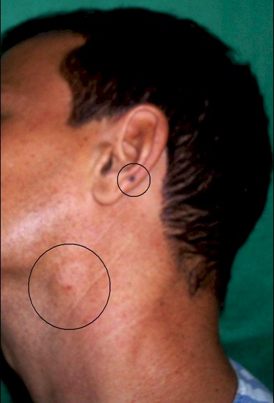 melanomas/melanoma_metastasis melanomas/melanoma_metastasis