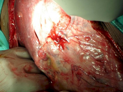 neuroblastoma_laparotomia_extirpacion_reseccion_2