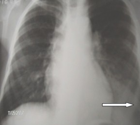 secuestro_pulmonar_intralobar_1
