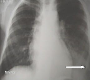 secuestro_pulmonar_intralobar_1 secuestro_pulmonar_intralobar_1