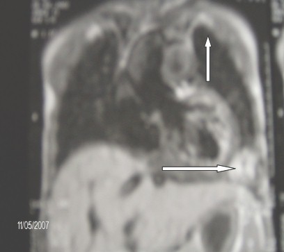 secuestro_pulmonar_intralobar_3 secuestro_pulmonar_intralobar_3