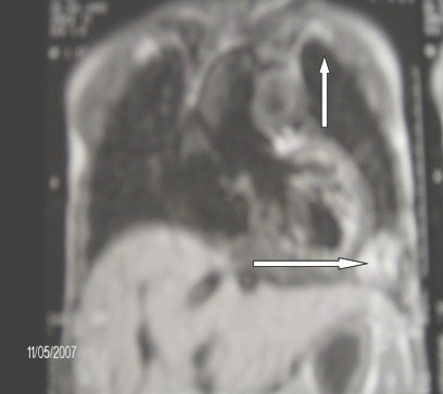 secuestro_pulmonar_intralobar_3