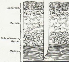 intramuscular