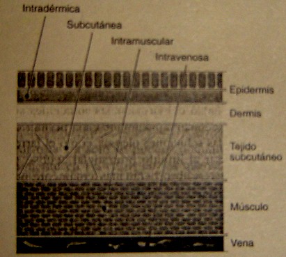 parenteral