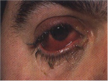 conjuntivitis2