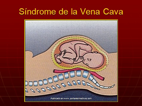 cambios_embarazo/cambios_embarazo_sindrome_vena_cava