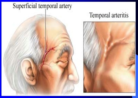 Temporal Arteritis picture: