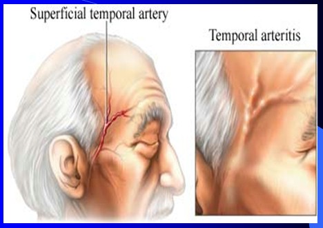 cefaleas_cefalalgias_cefalalgia/cefalea_arteritis_temporal cefaleas_cefalalgias_cefalalgia/cefalea_arteritis_temporal