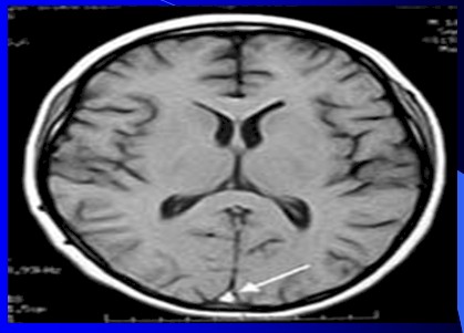 cefaleas_cefalalgias_cefalalgia/cefalea_hipertension_intracraneal_TAC cefaleas_cefalalgias_cefalalgia/cefalea_hipertension_intracraneal_TAC