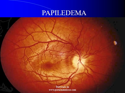 cefaleas_cefalalgias_cefalalgia/cefalea_papiledema_fondo_ojo cefaleas_cefalalgias_cefalalgia/cefalea_papiledema_fondo_ojo