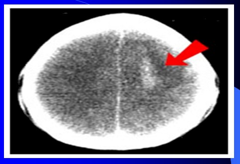 cefaleas_cefalalgias_cefalalgia/cefalea_tumor_SNC cefaleas_cefalalgias_cefalalgia/cefalea_tumor_SNC