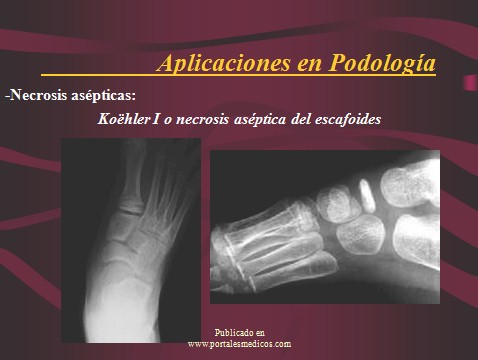 crioelectroforesis/crioelectroforesis_aplicaciones_podologia_necrosis_escafoides