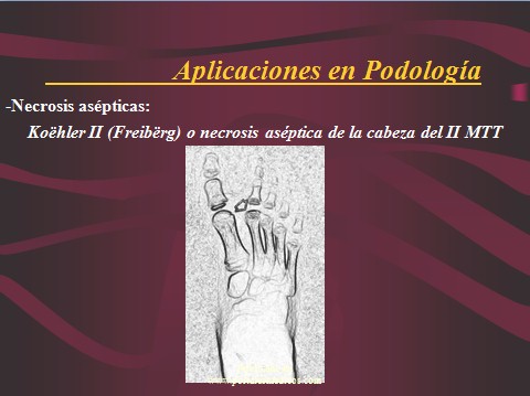 crioelectroforesis/crioelectroforesis_podologia_necrosis_escafoides_2