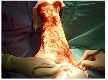 dermolipectomia_cirugia_bariatrica/lipectomia_abdomen_colgajo_abdominal dermolipectomia_cirugia_bariatrica/lipectomia_abdomen_colgajo_abdominal
