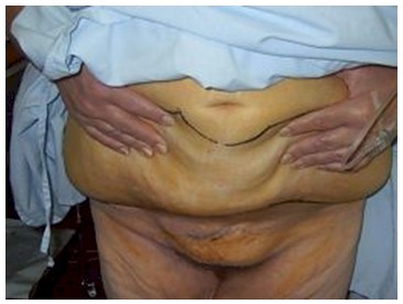 dermolipectomia_cirugia_bariatrica/lipectomia_abdomen_incisiones