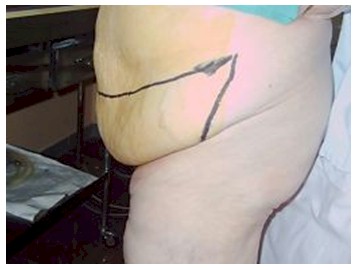 dermolipectomia_cirugia_bariatrica/lipectomia_abdomen_incisiones_2 dermolipectomia_cirugia_bariatrica/lipectomia_abdomen_incisiones_2