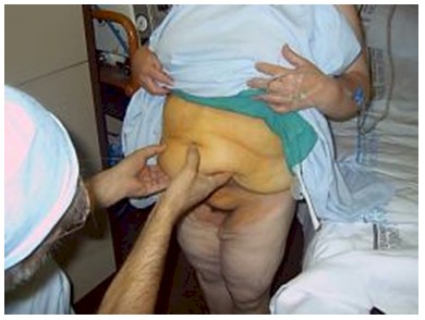 dermolipectomia_cirugia_bariatrica/lipectomia_abdomen_obesidad_morbida
