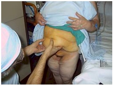 dermolipectomia_cirugia_bariatrica/lipectomia_abdomen_obesidad_morbida dermolipectomia_cirugia_bariatrica/lipectomia_abdomen_obesidad_morbida